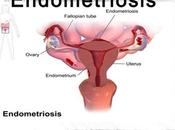 Most Effective Herbs Cure Endometriosis