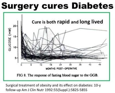 Is Bariatric Surgery Like Fasting in Type 2 Diabetes Treatment?