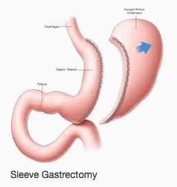 Is Bariatric Surgery Like Fasting in Type 2 Diabetes Treatment?