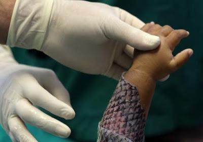 will Tilapia fish help treating skin burns ~ Brazilian research !!