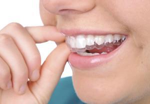 invisalign-dental-braces