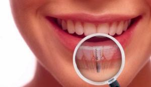 Can you wear braces if you have a dental implant?
