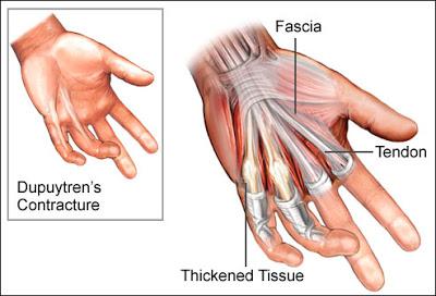 Friday Q&A: Dupuytren's Contracture