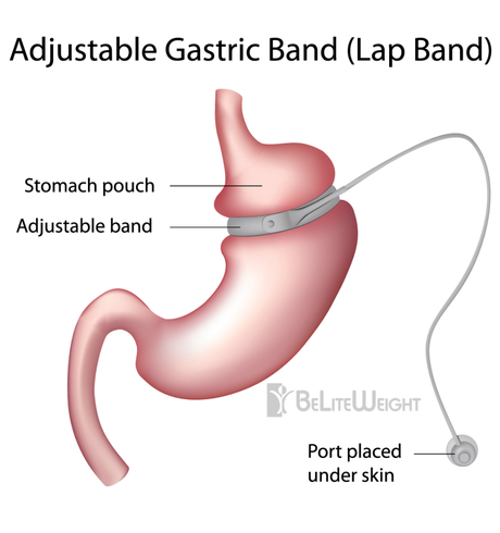Lap Band, Gastric Sleeve, Bypass: A History of Weight Loss Surgery