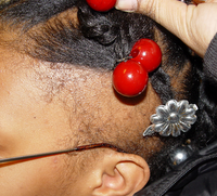 Spotlight on Traction Alopecia