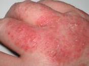 Eczema?