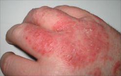Photograph of typical, mild dermatitis