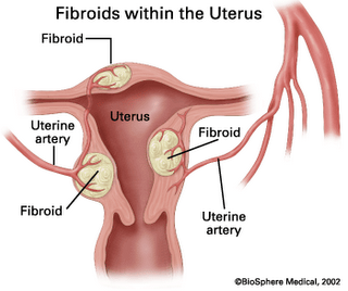 STUDIES SHOW | Can Relaxers Cause Uterine Fibroids and Premature Puberty?