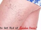 Spider Veins Natural Home Remedies