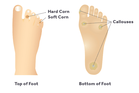 What Causes Foot Calluses and Corns?
