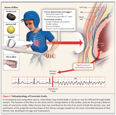 Commotio Cordis – how hits to the chest turn deadly