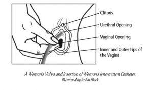 Neither a Mirror or Holding the Labia Help Women while Using an Intermittent Catheter