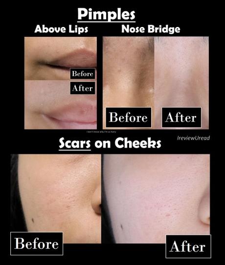 See acne improvement with Hiruscar Anti Acne Range | Sponsored