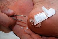 Image: Remove a Splinter with Baking Soda