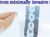 Special Offer Laser Spine Surgery India Patients from Zambia