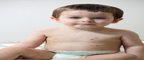 9 Best Home Remedies for Chickenpox in kids-Home Remedies-Healthyhealthng