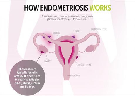 Endometriosis can cause Bladder and Bowel Problems