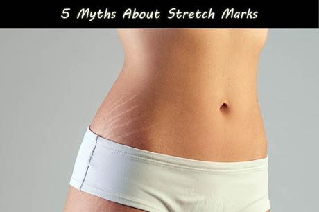 5 Myths About Stretch Marks