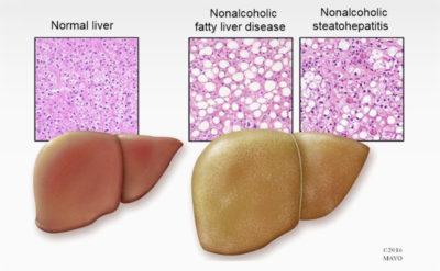 How fat is your liver?