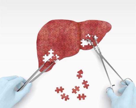 Fatty liver disease fastest-growing reason for transplants in young U.S. adults