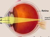 Presbyopia: Using Readers Make Appear Years Older