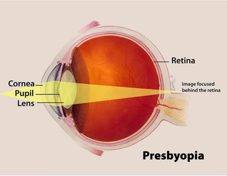 Presbyopia: Using Readers Make You Appear Ten Years Older