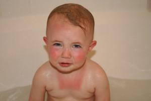 sunburned without using sunscreen