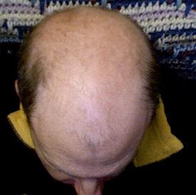 8 Football Hair Loss Cover-Ups