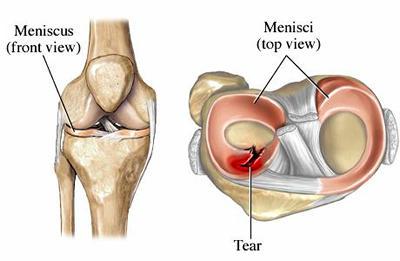 Treating Your Torn Meniscus