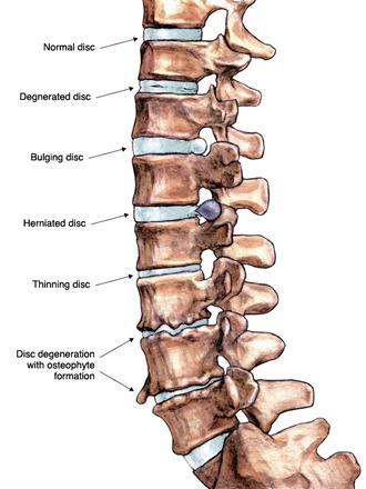 Degenerative Disc Disease and You: What You Need to Know