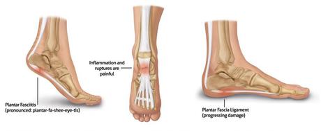 Seeking Help for Plantar Fasciitis