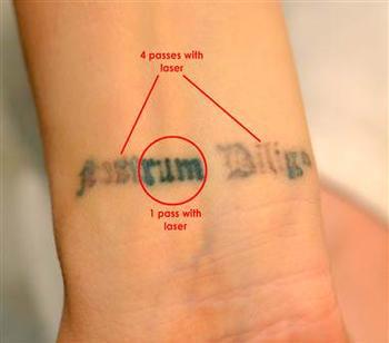 R20 Tattoo Removal