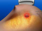 Laser Therapy Treatment Breast Cancer