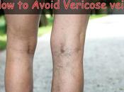 Avoid Varicose Veins Vein Treatment?