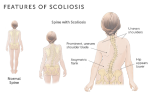 I have Scoliosis