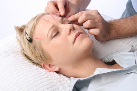 Can Facial Acupuncture Really Make You Look Younger?