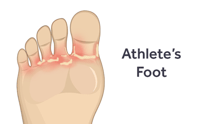 prevent-diagnose-treat-athletes-foot