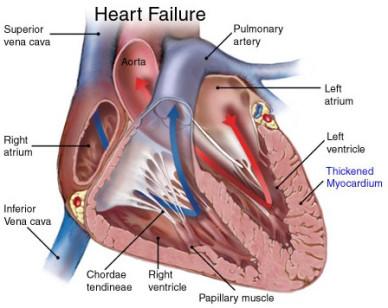 Heart failure surgery India Comes with high success rate for a wonderful healthcare experience