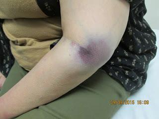 Newly obtained photograph shows Carol could not have broken her own arm -- and deputies started shaping their bogus story the morning after her injury