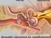 Acoustic Neuroma Surgery India Cures Ailments Skilfully with Morbidity