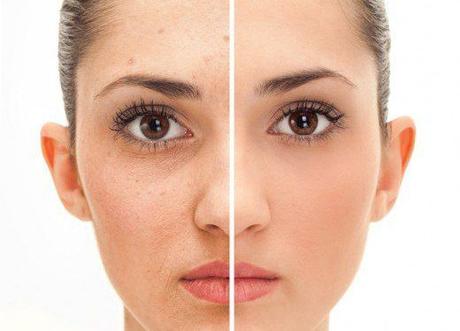 Photofacials vs. Laser Skin Treatments