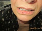 Photograph Shows Carol's Split Lip, Likely Result Slamming Ground, Helps Prove Deputies Lying About Cause Broken