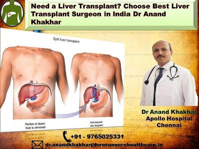 Need a Liver Transplant? Choose Best Liver Transplant Surgeon in India Dr Anand Khakhar