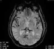 Decoding The Superficial Siderosis MRI