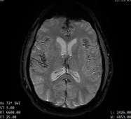 Decoding The Superficial Siderosis MRI