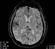 Decoding The Superficial Siderosis MRI