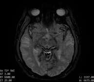 Decoding The Superficial Siderosis MRI