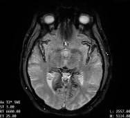 Decoding The Superficial Siderosis MRI