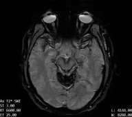 MRI Superficial Siderosis