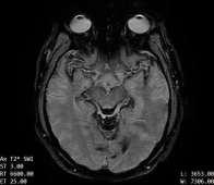 Decoding The Superficial Siderosis MRI